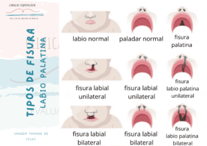 Los diferentes tipos de fisura labio palatina que podemos encontrar son: fisura labial unilateral, fisura labial bilateral, fisura palatina, fisura labio palatina unilateral y fisura labio palatina bilateral.