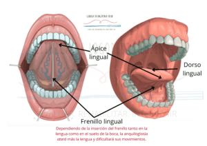 Dependiendo de la inserción o anclaje del frenillo lingual tanto en la lengua como en el suelo de la boca, la anquiloglosia "atará" más la lengua y dificultará sus movimientos.