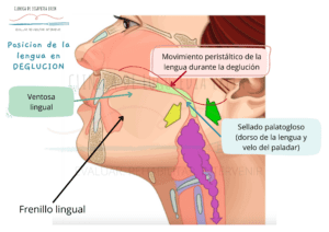 La anquiloglosia (frenillo lingual alterado) puede dificultar los movimientos linguales durante la deglución (ventosa lingual, movimiento peristáltico para manejo del bolo, retracción y elevación del dorso de la lengua -sellado palatogloso-).