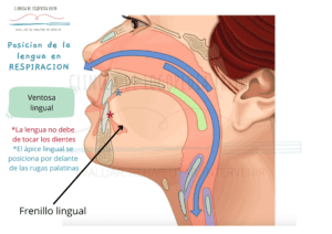La anquiloglosia (frenillo lingual alterado) puede dificultar la elevación de la lengua en su posición de reposo, durante la respiración (ventosa lingual), alterando con ello el patrón respiratorio, pasando de una respiración nasal a una oral.